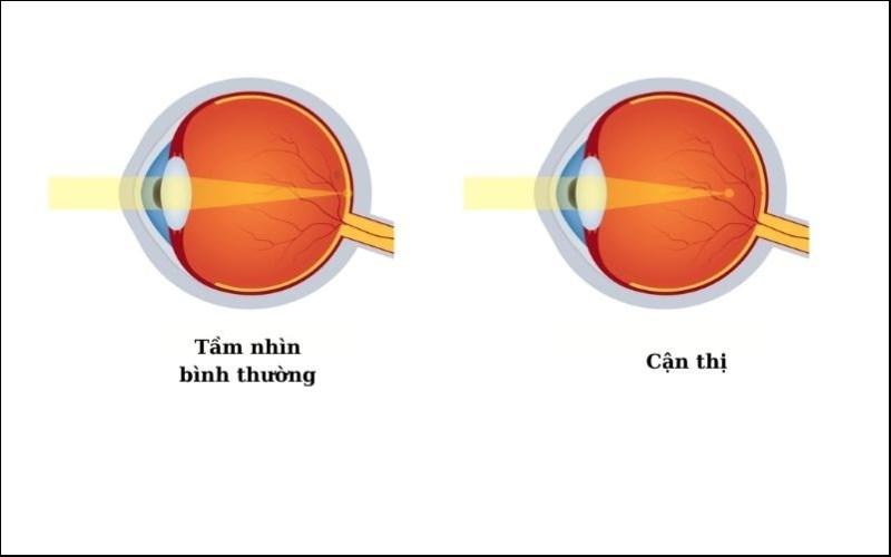 Mắt cận thị nhìn qua võng mạc