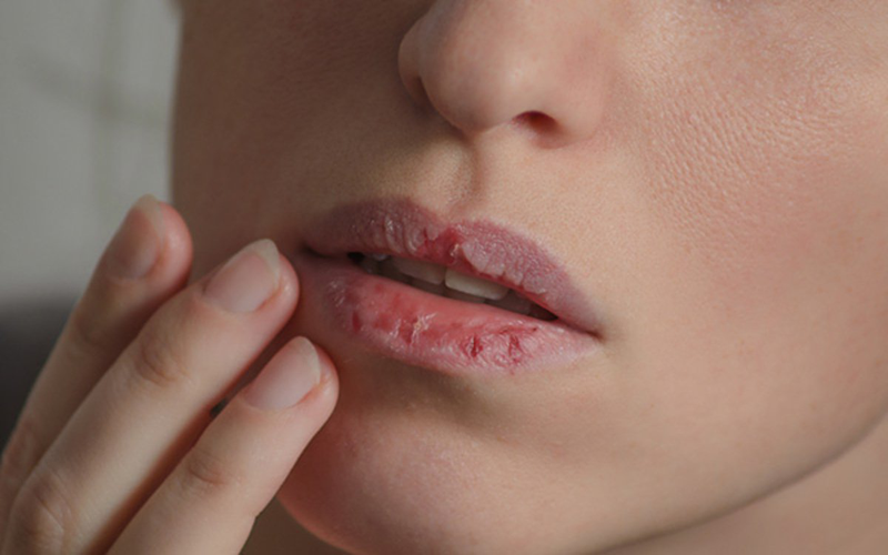 Dị ứng son môi là gì? Nguyên nhân và phương pháp chữa trị? 2