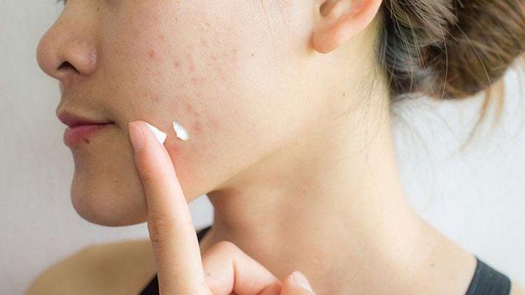 Dược phẩm có chứa Azelaic acid có thể dùng để điều trị mụn trứng cá