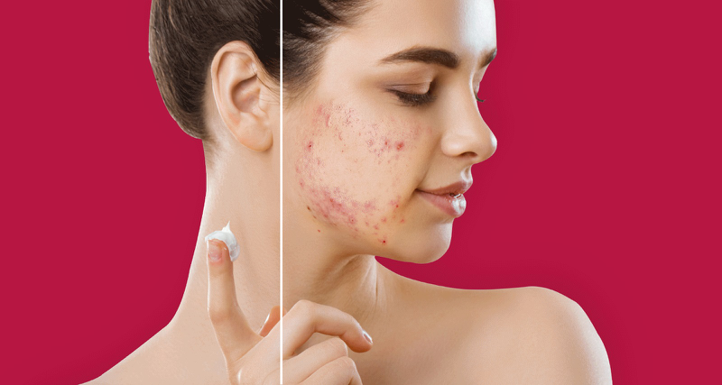 Non comedogenic là gì? Cách sử dụng sản phẩm Non comedogenic hiệu quả